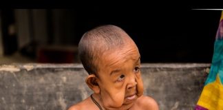 À 4 ans seulement, ce jeune garçon ressemble à un vieillard de 80 ans