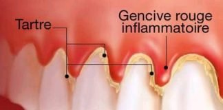santé dentaire: Voici les Causes et les symptômes de la gingivite.