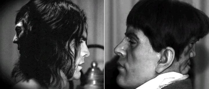 Découvrez l'histoire incroyable de ce jeune homme de 23 ans avec ses deux visages 2 Découvrez l'histoire incroyable de ce jeune homme de 23 ans avec ses deux visages 2