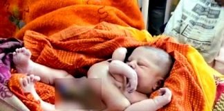 Un bébé est né avec 4 bras et 4 jambes en Inde !