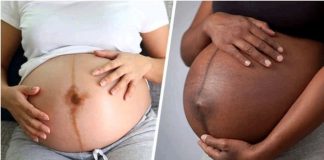 Tout savoir sur la ligne sombre qui apparaît pendant la grossesse chez la femme et disparaît après la naissance