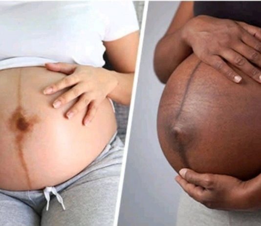 Tout savoir sur la ligne sombre qui apparaît pendant la grossesse chez la femme et disparaît après la naissance