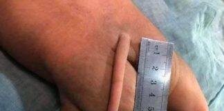 Un nouveau-né avec une queue de près de 13 centimètres de long au Mexique !