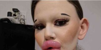 Exaspérée par sa beauté, elle dépense 20 000 euros pour devenir la femme aux lèvres les plus grosses du monde !