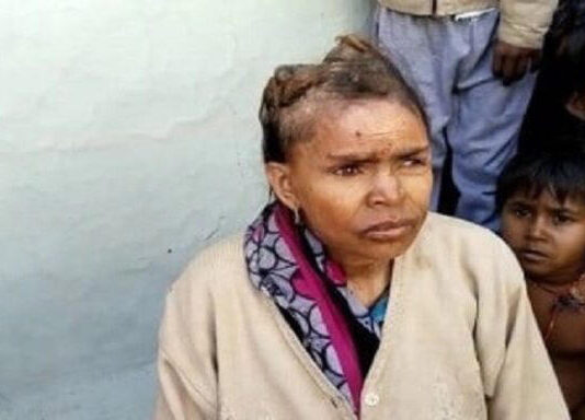 Une femme développe des «cornes» sur la tête