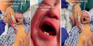 Une femme donne naissance à un bébé avec des dents